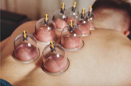 Cupping Therapy